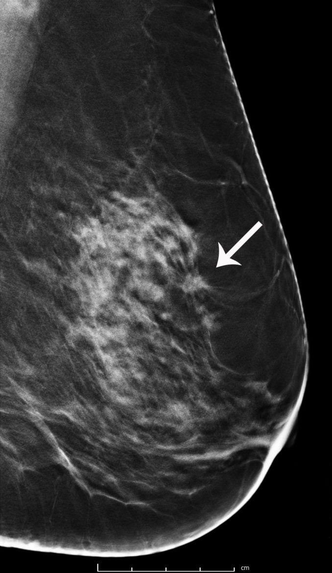 breast-cancer-screening-with-3d-mammography-or-tomosynthesis